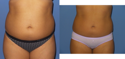 32 y/o female with one treatment of SculpSure to her abdomen and flanks. - 32 y/o female shown 12 weeks after second treatment of SculpSure to her abdomen and flanks.