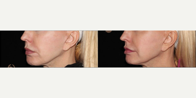 Woman treated with CO2 Laser - CO2RE, Fractional CO2 Resurfacing treatment