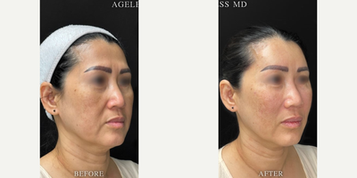 45-54 year old woman treated with Renuva - 9ML Renuva for the Mid Face and Forehead