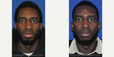 Man treated with African American Rhinoplasty - Man treated with African American Rhinoplasty