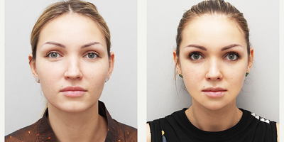25-34 year old woman treated with Jaw Reduction - Had Jaw Reduction (V-line procedure) and a Zygoma reduction and rhinoplasty revision