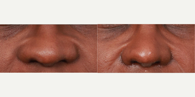 Woman treated with Alarplasty - Woman treated with Alarplasty.
