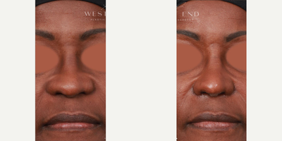 Woman treated with Alarplasty - Woman treated with Alarplasty.