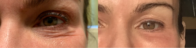 35-44 year old woman treated with CO2 Laser - 35-44 year old woman treated with CO2 Laser for improvement of appearance of fine lines and brown spots as well as to tighten the skin.