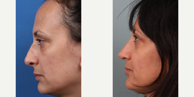 35-44 year old woman treated with Revision Rhinoplasty, Asian Rhinoplasty - Revision rhinoplasty with rib cartilage graft