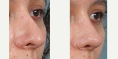 25-34 year old woman treated with Revision Rhinoplasty, Asian Rhinoplasty - 4th revision rhinoplasty, close up photos per patient privacy