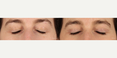 Upper Blepharoplasty (Eyelid Lift) with Laser Resurfacing - 49-year-old female who desired eyelid refresh. In-office volume-preservation upper blepharoplasty along with fully ablative Erbium:YAG laser resurfacing was performed. Notice the restored upper eyelid show and volume and skin health around the eyes. Also note how makeup no longer cakes into the upper eyelid crease.