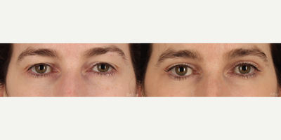 Upper Blepharoplasty (Eyelid Lift) with Laser Resurfacing - 49-year-old female who desired eyelid refresh. In-office volume-preservation upper blepharoplasty along with fully ablative Erbium:YAG laser resurfacing was performed. Notice the restored upper eyelid show and volume and skin health around the eyes. Also note how makeup no longer cakes into the upper eyelid crease.