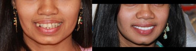 All-on-4 Dental Implants - All-on-4 Dental Implants