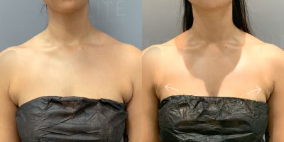 25-34 year old woman treated with AirSculpt - Patient received Front Bra Roll AirSculpt which is fat removal all while awake. Results are showcasing 6 months post-op and was performed in our Toronto Clinic.