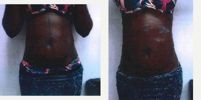 18-24 year old woman treated with Skin Rejuvenation Body Fx & Body Plus - Female patient preparing for a photo shoot. 1 treatment of Body Fx, fat reduction and Body Plus, skin tightening. Before and after pictures taken same day.