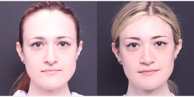 25-34 year old transgender woman treated with Facial Feminization Surgery, Rhinoplasty, Jaw Reduction - browlift, brow bone reduction, hairline advancement, rhinoplasty, thyroplasty, mandible/chin contouring, submental liposuction