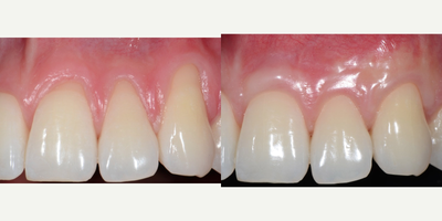 25-34 year old man with multiple gingival recessions treated with root coverage procedures - The patient presented with multiple gingival recessions affecting the front teeth. 
Alloderm graft was adopted to cover the exposed roots.