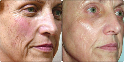 Pixel Laser - Woman treated with Pixel Laser