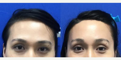 Transgender woman treated with Forehead Reduction - Transgender woman treated with Forehead Reduction