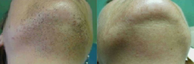 Man treated with Laser Hair Removal - Man treated with Laser Hair Removal