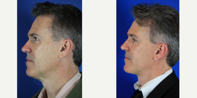 Patient treated with Deep Plane Facelift - Patient treated with Deep Plane Facelift