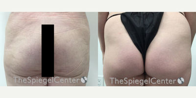 25-34 year old transgender woman treated with Nonsurgical Butt Lift - 25-34 year old transgender woman treated with Nonsurgical Butt Lift