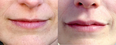 Case #restylane to lips - Enhancement of upper lip performed with restylane.