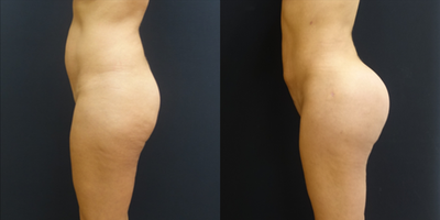45-54 year old woman treated with Butt Lift - The patient underwent a butt augmentation with 455cc butt implants, liposculpting and fat transfer. The combination of the liposculpting and the fat transfer transforms her from a square to hourglass figure. The 455cc round butt implants give her the perfect size for her body frame.