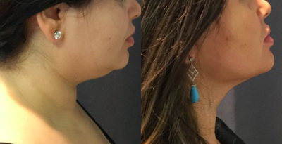 25-34 year old woman treated with PrecisionTx - Precision tx / Smartlipo of chin and lower face