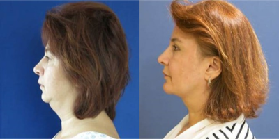 45-54 year old woman treated with Facelift - Endoscopic forehead and midface lifting, eyebrow lifting, upper and lower eyelid job, fat grafting, neck lifting