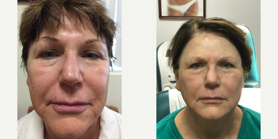 55-64 year old woman treated with Non Surgical Face Lift - Non surgical face and neck lift with a combination of laser and Ultherapy and fillers. All under local anesthesia and with only a 5 to 7 day downtime
