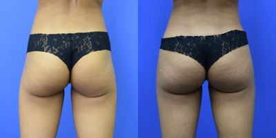 25-34 year old woman treated with Hip Augmentation - This 25-year-old patient of Dr. Bachilo desired a subtle and natural enhancement to her hips. She is seen here before and after just one month after a bilateral hip augmentation using silicone hip implants.
