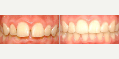 35-44 year old man treated with Lingual Braces - Lingual Braces Treatment