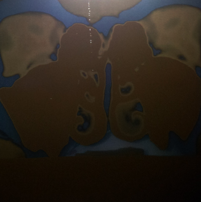 Is this chronic sinusitis? Left side of face have been ...