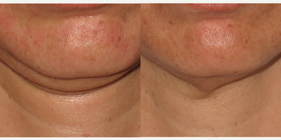 35-44 year old woman treated with Infini RF - Infini Treatment to lower face and neck