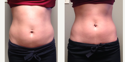25-34 year old woman treated with UltraShape - We treated abdomen 3 session, 2 weeks apart. These are 1 month after the 3rd session. No changes in weight or activity level.