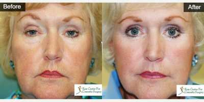 65-74 year old woman treated with Eyelid Surgery, Ptosis Surgery - This spritely 72 year old came to the Kass Center complaining she felt like her eyes made her look older than she felt. Bilateral upper and lower blepharoplasties with festoon treatments were performed on her.