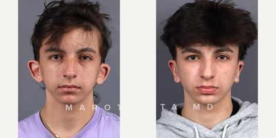 Man treated with Ear Surgery - Ear surgery, also known as otoplasty, can improve the shape, position or proportion of the ear. A defect in the ear structure that is present at birth or that becomes apparent with development can be corrected by otoplasty. This procedure can also treat misshapen ears caused by injury. Otoplasty creates a more natural shape while bringing balance and proportion to the ears and face. Correction of even minor deformities can have profound benets to appearance and self-esteem.