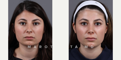 Woman treated with Rhinoplasty - Great results from our patients journey. Transformation through Rhinoplasty/Septoplasty by Dr James Marotta