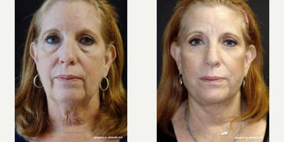 Woman treated with QuickLift - Woman treated with QuickLift