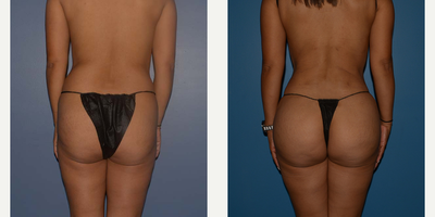 35-44 year old woman treated with Rib Removal - This patient underwent removal of 11 and 12th rib with lipo 360 and BBL