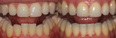 38 year old man treated with Lingual Braces - Inside (lingual) braces were used to correct the crowding of the lower front teeth. Once the lower front teeth were straightened, a fixed retainer was placed to maintain them in their new position. These cannot be seen from the front view during treatment and were a great esthetic option.