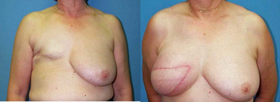 TRAM - 
	Five years after right mastectomy. She desires breast reconstruction with her own tissue.