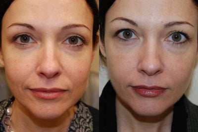 Silikon-1000 treatment for nasolabial folds - 
	These photos demonstrate improvement of nasolabial folds using Silikon-1000, an off-label filler for permanent results. You can see a natural-looking, attractive improvement after a single treatment.
