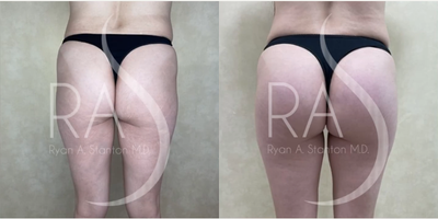 Woman treated with Butt Implants - Woman treated withButt Implants