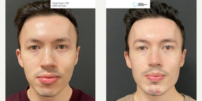 25-34 year old man treated with Chin and Jaw Implant - Jaw and Chin Implant