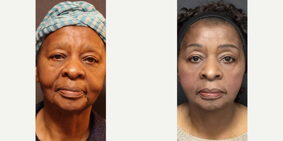 Woman treated with Mini Facelift - Woman treated with Mini Facelift
