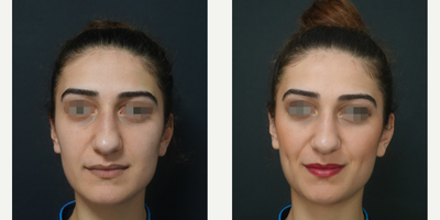 25-34 year old woman treated with Dimpleplasty - Dimple Surgery - 9 Days post-op