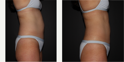 35-44 year old woman treated with UltraShape Power - 35-44 year old woman treated with UltraShape Power for 3 treatments