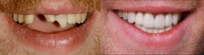 Trauma, Implants, Full Restoration - 
	Patient experienced severe trauma.
