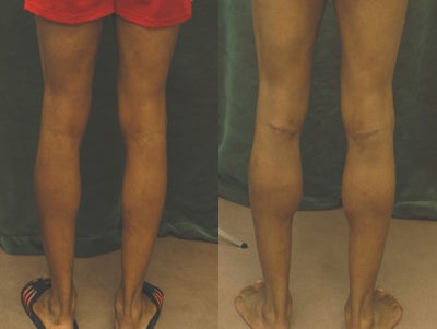 Men's Calf Augmentation  - 
	Men&#39;s Calf Augmentation W/Implants
