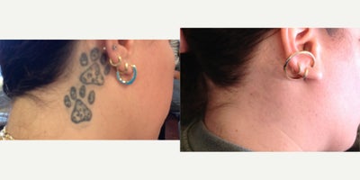 18-24 year old woman treated with Tattoo Removal - Picosure tattoo removal