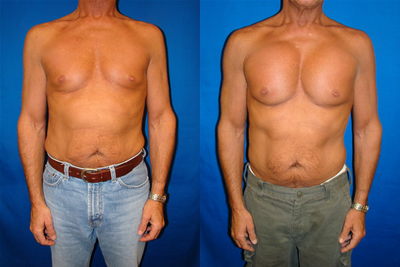 Pectoral Implants - 
	This 54-year old patient was interest in pectoral implants. In order to achieve the patient desired look, Dr. Pousti used Pectoral 4 (Aiache) in size 3 made by Spectrum Design Incorporated. The patient is now 5 months post-op surgery.

