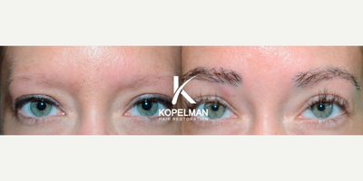 35-44 year old woman treated with Eyebrow Transplant - Age: 40Gender: FemaleProcedure: Eyebrow Hair TransplantGrafts: 600Procedure Description: Desired a more defined eyebrow shape. Photos taken before and one year after the procedure.